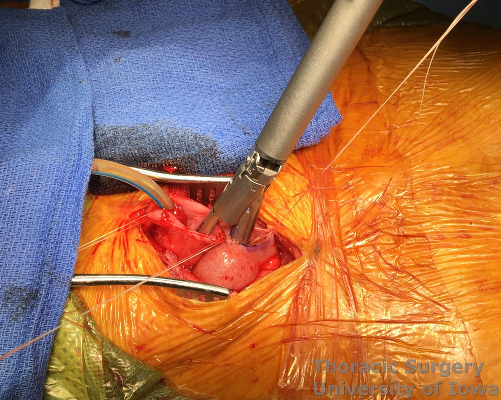 linear cutting stapler is placed into the cervical esophagus and gastric conduit