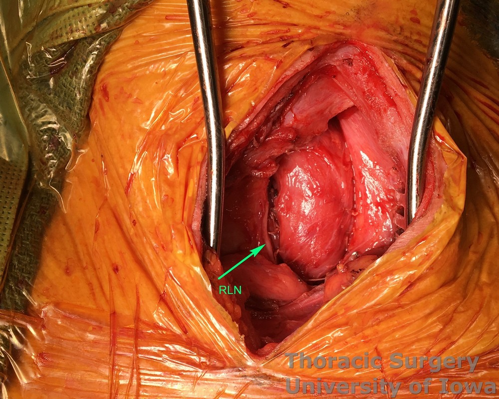 Esophagectomy for esophageal carcinoma cervical gastro esophageal anastomosis the supporting sponge is removed and anastomosis is allowed to retract behind manubrium