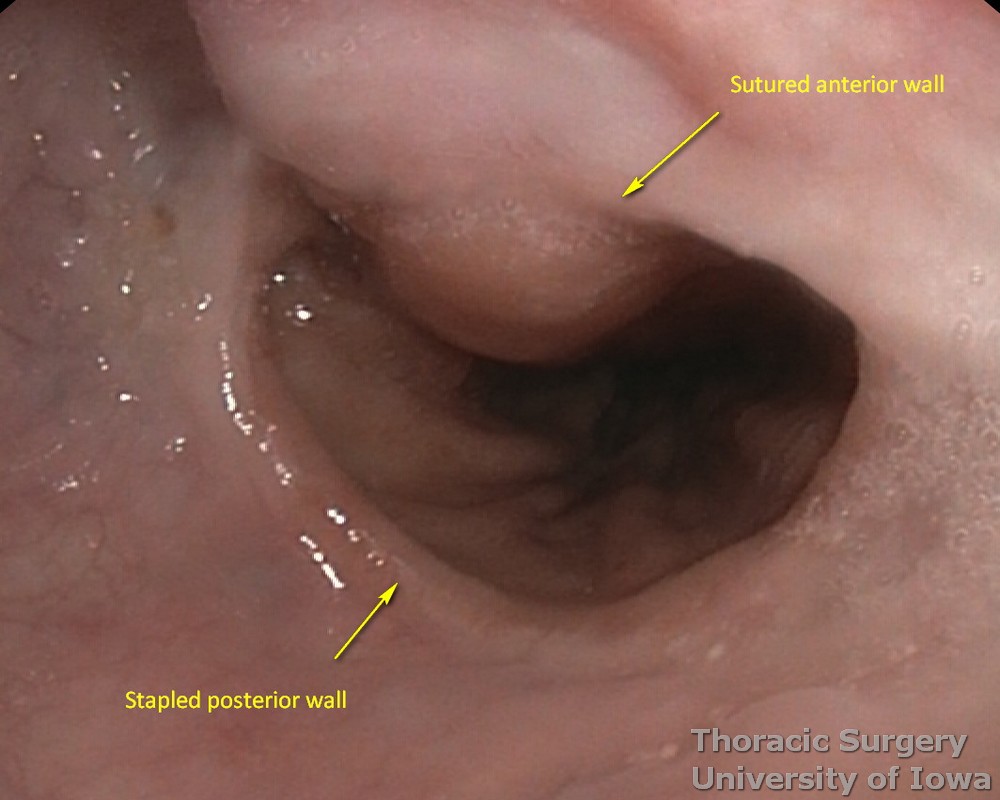 Esophagectomy for esophageal carcinoma cervical gastroesophageal anastomosis postoperative Flexible endoscopy demonstrating patent anastomosis 