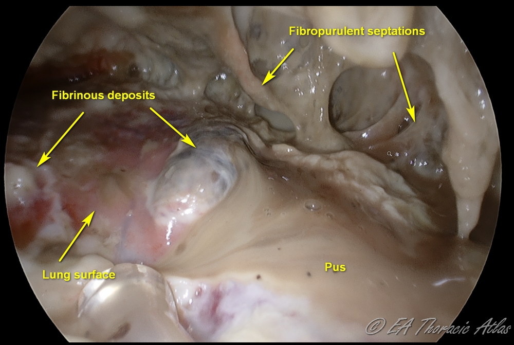 Fibropurulent phase of the empyema (stage II) with purulent effusion, extensive debris and intrapleural loculation 