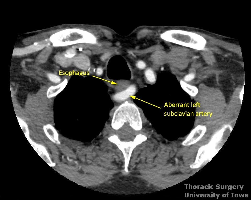 Preoperative CTA demonstrating an aberrant retroesophageal left subclavian artery in patient who underwent uncomplicated three incision esophagectomy. 