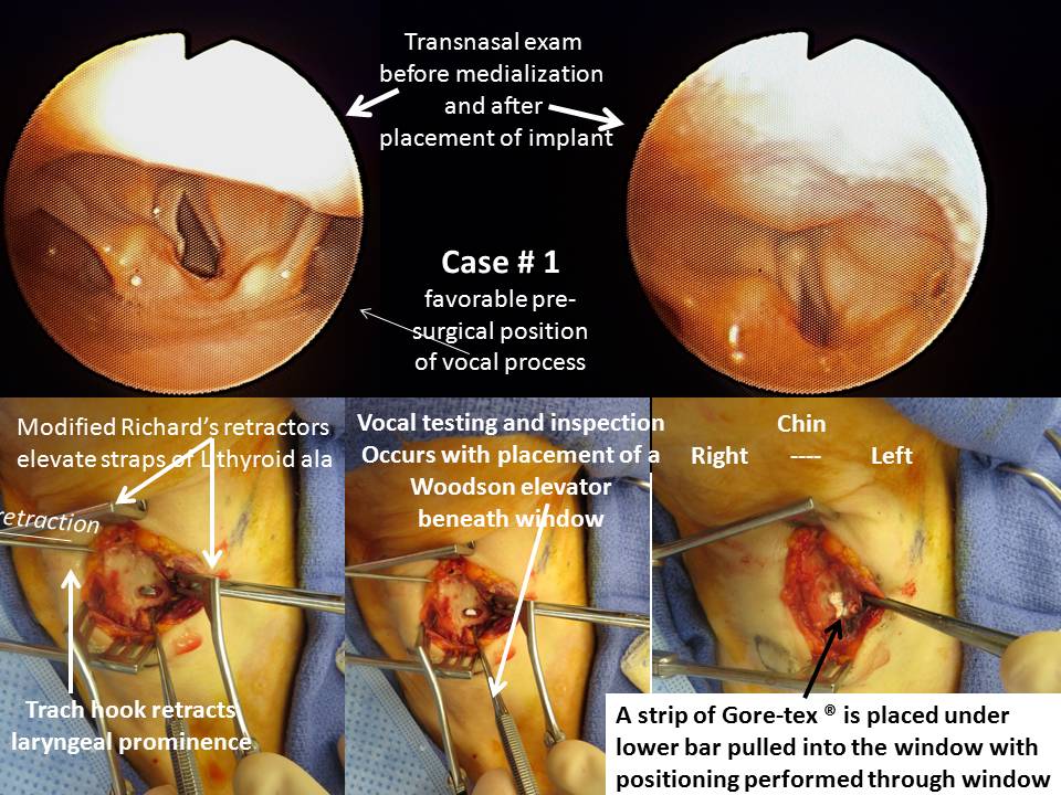 goretex thyroplasty