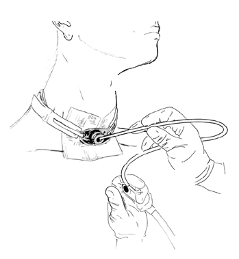 tracheostomy3
