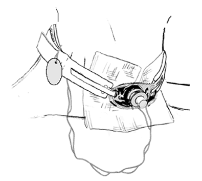 tracheostomy4