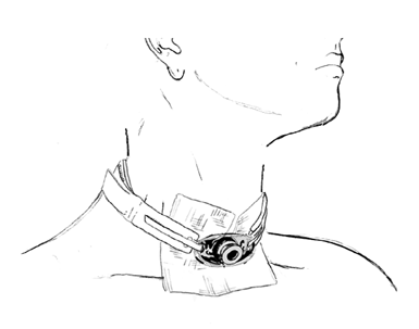 tracheostomy6