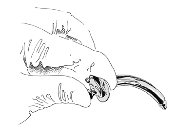 tracheostomy7