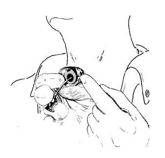 tracheostomy9